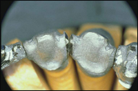 Имплантаты, лазер и титан: триумвират современной стоматологии