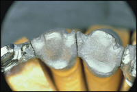 Имплантаты, лазер и титан: триумвират современной стоматологии