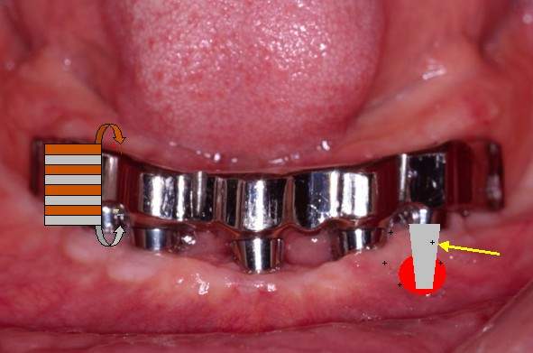 Имплантанты, лазер и титан: триумвират современной стоматологии