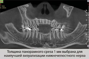 Опыт использования стоматологического томографа NewTom 3G в условиях обработки большого потока пациентов