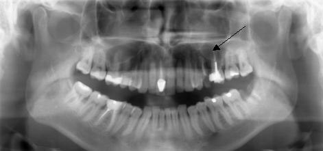 Замена сомнительного 25 зуба имплантатом