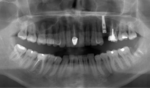 Установка имплантата одномоментно с удалением 25 зуба